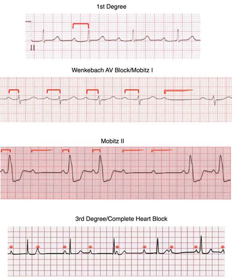 ecg bella